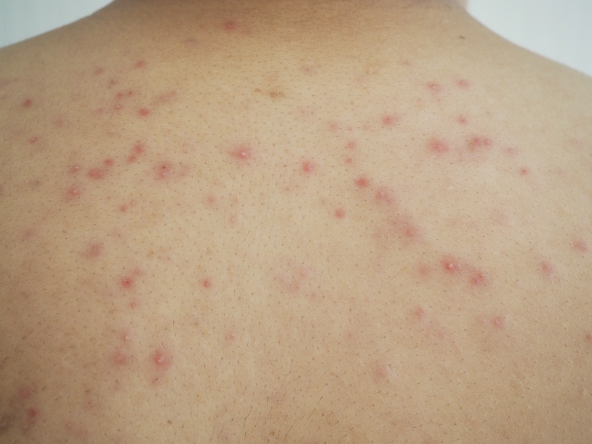 Heat rash or prickly heat