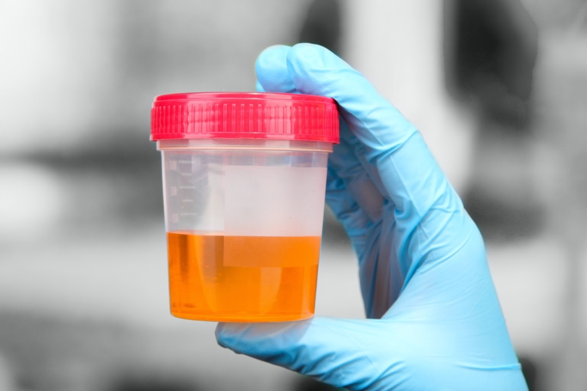 Medical urine test, close-up