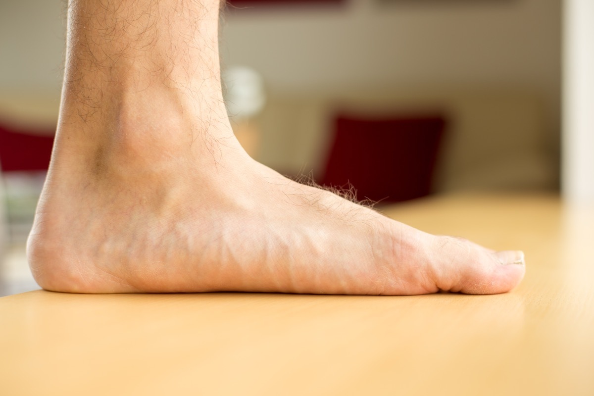 Flatfoot Aching Feet foot pain