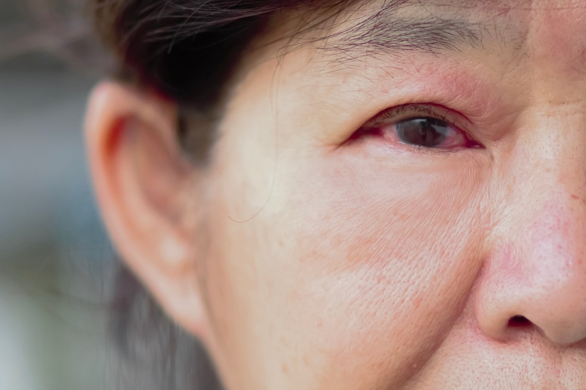 Older woman with pinkeye