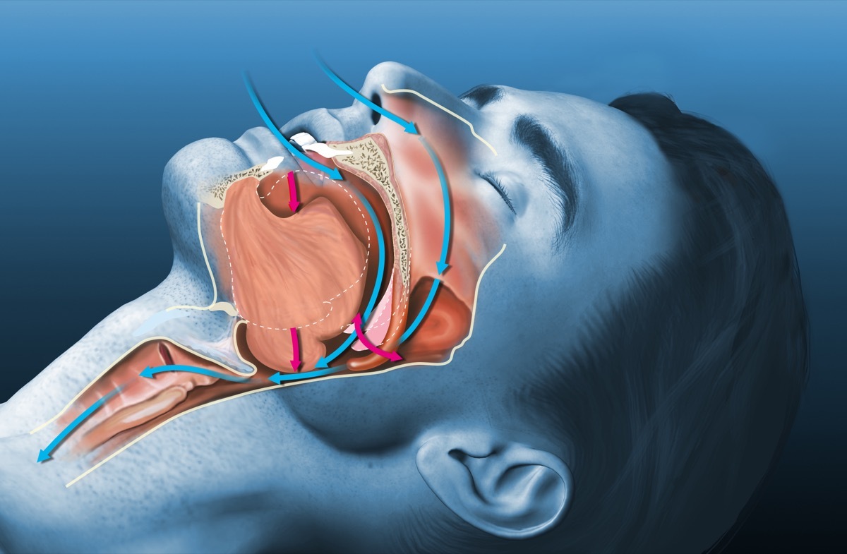 Sleep Apnea Diagram