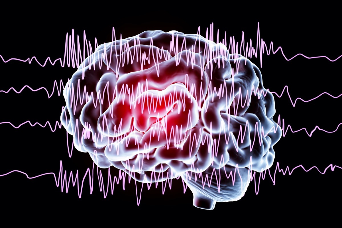 Brain and encephalography in epilepsy patient during seizure attack