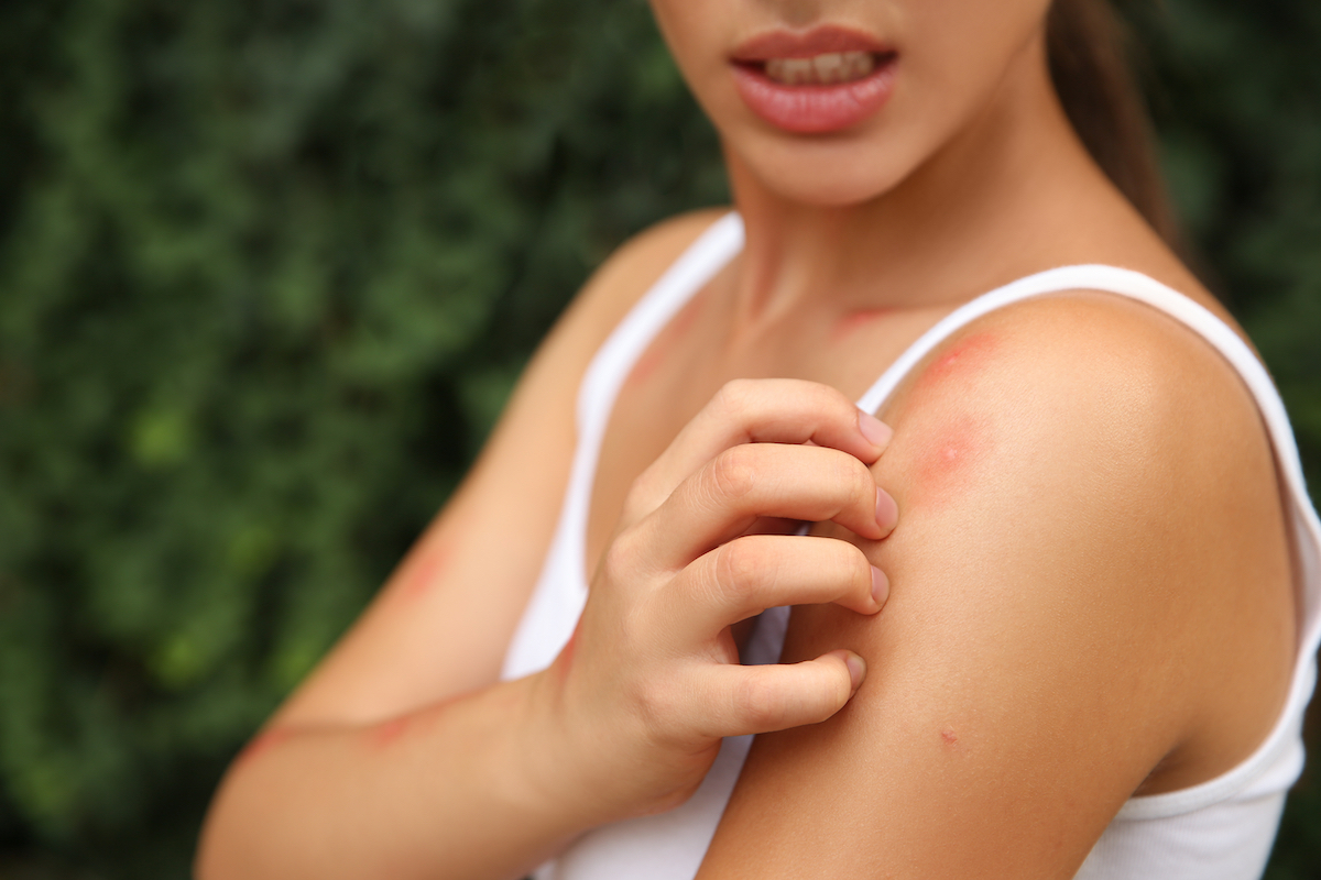 Woman outside scratching mosquito bites on her shoulder